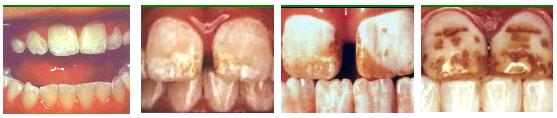 Pictures of dental fluorosis